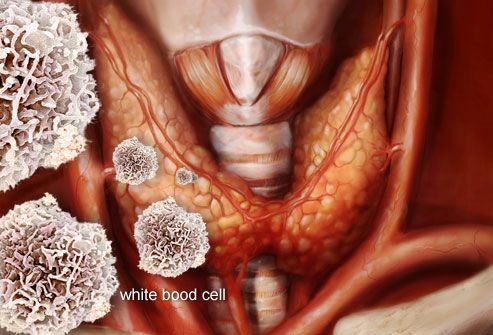 Illustration Of Hashimotos Disease
