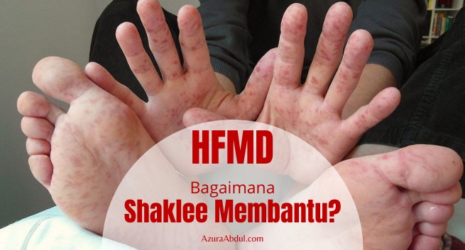 HFMD: Bagaimana Shaklee membantu? | Azura Abdul